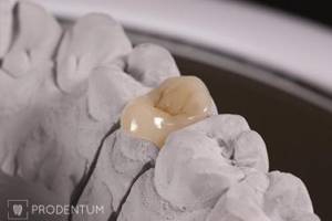 Dantų protezavimas