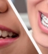 Dantų tiesinimas ortodontiniais aparatais